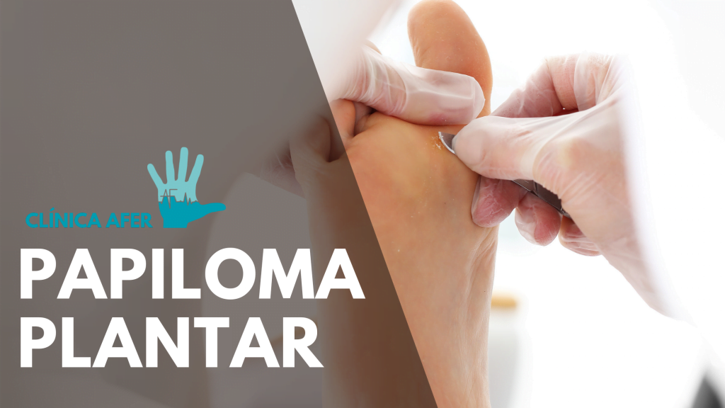 Imagen del artículo sobre Papiloma o verruga plantar