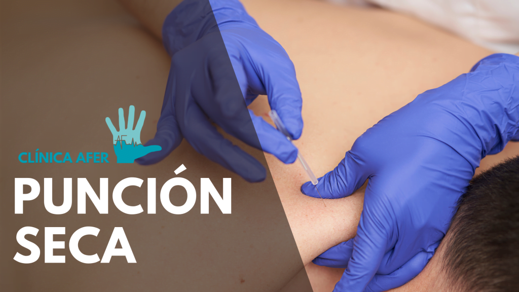 Imagen del artículo sobre la Punción Seca