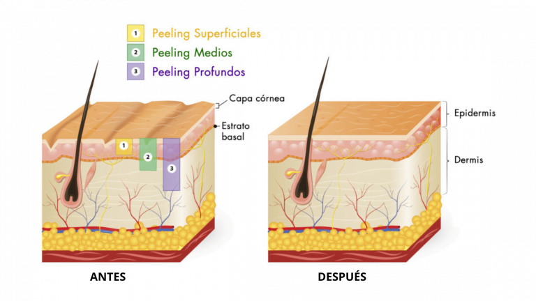 imagen de la entrada de blog sobre peeling facial